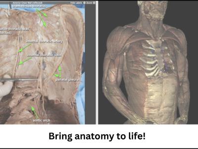 View of VH Dissector showing internal Anterior Chest Wall with a phrase stating "Bring anatomy to life!".