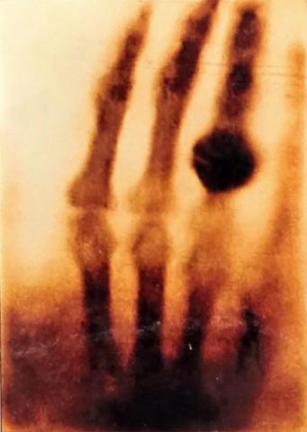 Xray of a hand